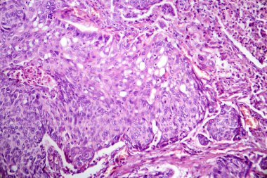 Akciğer adenokarsinomunun fotomikrografı, en yaygın akciğer kanserinin karakteristik kötü huylu salgı hücrelerini gösteriyor..