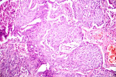 Akciğer adenokarsinomunun fotomikrografı, en yaygın akciğer kanserinin karakteristik kötü huylu salgı hücrelerini gösteriyor..