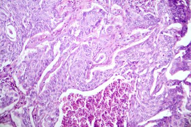 Akciğer adenokarsinomunun fotomikrografı, en yaygın akciğer kanserinin karakteristik kötü huylu salgı hücrelerini gösteriyor..
