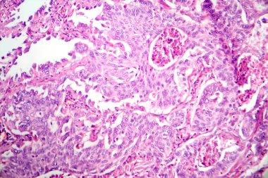 Akciğer adenokarsinomunun fotomikrografı, en yaygın akciğer kanserinin karakteristik kötü huylu salgı hücrelerini gösteriyor..