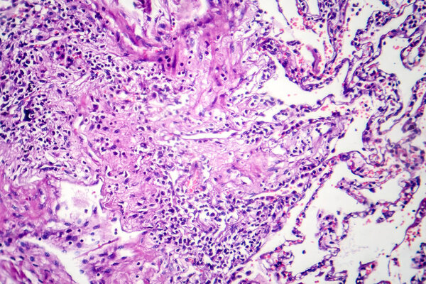 Фотомикрограф легких курильщика, выявление характерных изменений и повреждений, связанных с длительными привычками курения.