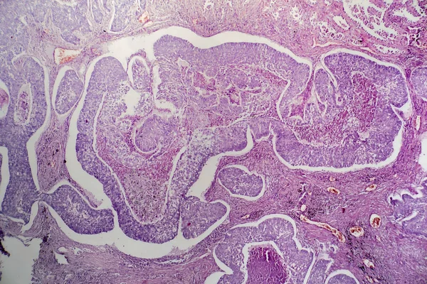Fotomicrografía Del Adenocarcinoma Pulmón Que Ilustra Las Células Glandulares Malignas — Foto de Stock
