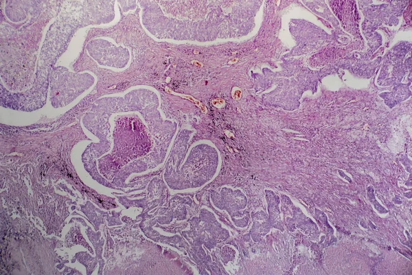 Fotomikrográf Tüdő Adenocarcinoma Illusztráló Rosszindulatú Mirigysejtek Jellemző Leggyakoribb Típusú Tüdőrák — Stock Fotó