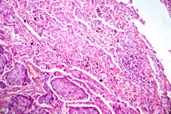 Photomicrograph of lung adenocarcinoma, illustrating malignant glandular cells characteristic of the most common type of lung cancer.