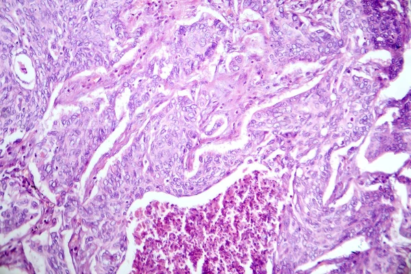 肺腺癌的显微照片 显示最常见类型肺癌的恶性腺细胞特征 — 图库照片