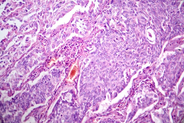 Fotomicrografia Adenocarcinoma Pulmonar Ilustrando Células Glandulares Malignas Características Tipo Mais — Fotografia de Stock