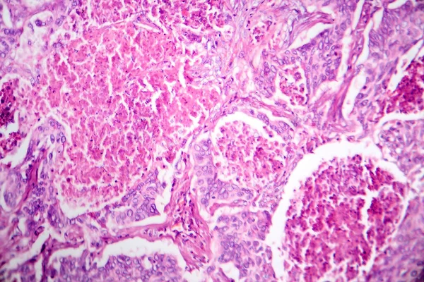Fotomicrogramma Dell Adenocarcinoma Polmonare Che Illustra Cellule Ghiandolari Maligne Caratteristiche — Foto Stock