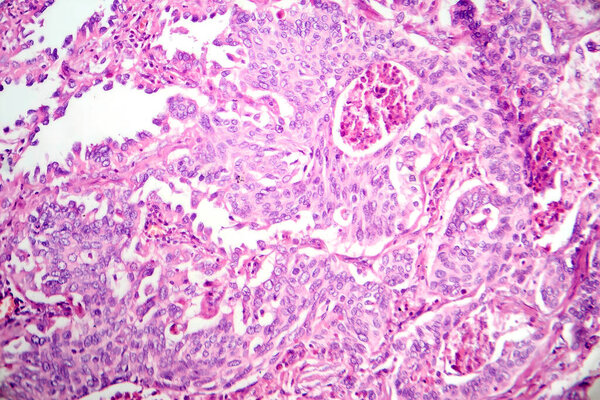 Фотомикрограф аденокарциномы легких, иллюстрирующий злокачественные железистые клетки, характерные для наиболее распространенного типа рака легких.