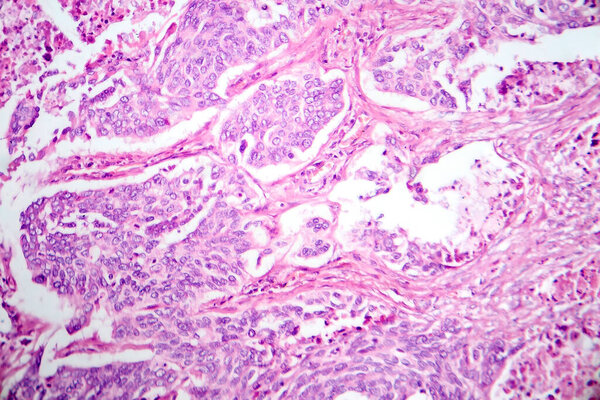 Фотомикрограф аденокарциномы легких, иллюстрирующий злокачественные железистые клетки, характерные для наиболее распространенного типа рака легких.