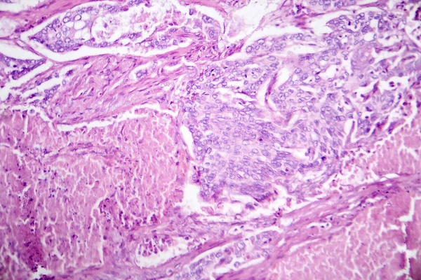 Fotomikrográf Tüdő Adenocarcinoma Illusztráló Rosszindulatú Mirigysejtek Jellemző Leggyakoribb Típusú Tüdőrák — Stock Fotó