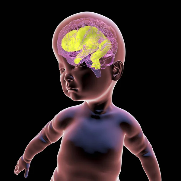 マクロスフィアと拡大された脳の心室を持つ赤ちゃんの科学的な3D図 異常な脳の成長に関連する状態 — ストック写真
