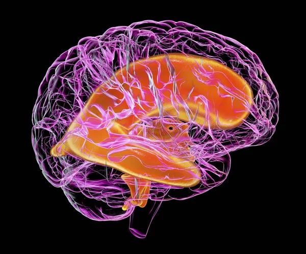 Vědecká Ilustrace Zobrazující Zvětšené Komory Dětského Mozku Hydrocefalus — Stock fotografie