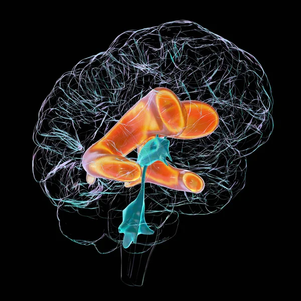 Vetenskaplig Illustration Som Skildrar Förstorade Ventriklar Hjärnan Hydrocefalus — Stockfoto