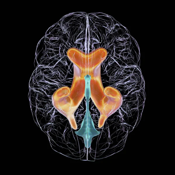 Illustrazione Scientifica Raffigurante Ventricoli Laterali Ingrossati Del Cervello Idrocefalo Vista — Foto Stock