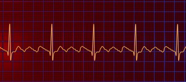 Atriyal kanat çırpmada EKG, atria 'nın düzenli kasılmalarıyla karakterize edilen anormal bir kalp ritmi. Karakteristik testere dişli P-dalgaları ve düzensiz ventriküler ritim gösteren 3D çizimler.