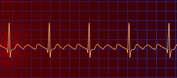 Ecg Flutter Atrial Ritmo Cardíaco Anormal Caracterizado Por Contrações Rápidas — Fotografia de Stock