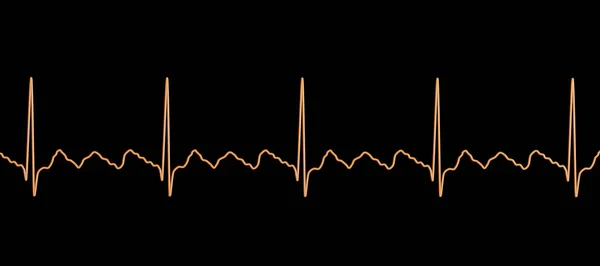 Экг Предсердии Аномальный Сердечный Ритм Характеризуется Быстрыми Регулярными Сокращениями Предсердий — стоковое фото