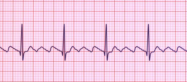 心电图在心房颤动 一种以快速 有规律的心房收缩为特点的不正常的心律 3D图像显示特征锯齿P波和不规则心室节律 — 图库照片