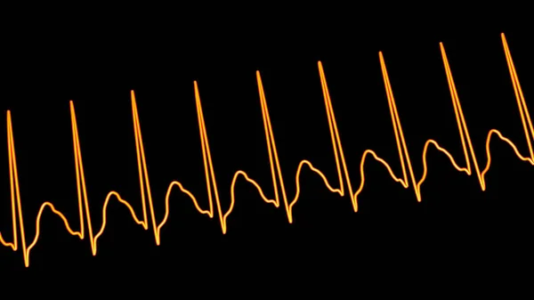 心臓を超える急速な心拍数である超心臓血管症のEcgは 動脈硬化やめまいを引き起こしています 3Dイラストは T波に隠された狭いQrs複合体とP波を示しています — ストック写真