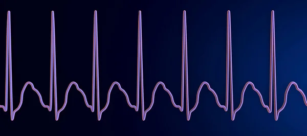 Ecg Taquicardia Supraventricular Una Frecuencia Cardíaca Rápida Que Origina Por —  Fotos de Stock