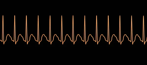 Ecg Taquicardia Supraventricular Uma Frequência Cardíaca Rápida Que Origina Acima — Fotografia de Stock