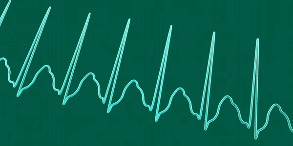 心臓を超える急速な心拍数である超心臓血管症のEcgは 動脈硬化やめまいを引き起こしています 3Dイラストは T波に隠された狭いQrs複合体とP波を示しています — ストック写真