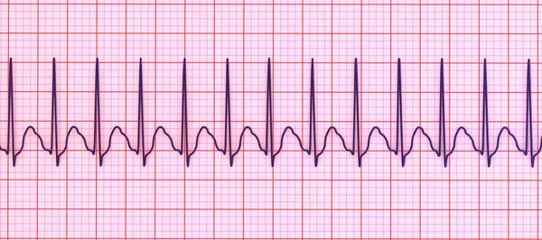 Ecg Taquicardia Supraventricular Una Frecuencia Cardíaca Rápida Que Origina Por — Foto de Stock