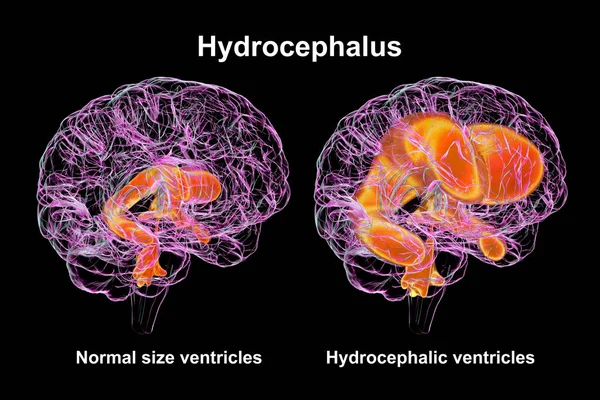 stock image A 3D scientific illustration depicting enlarged ventricles of the child brain (hydrocephalus, right side), and normal ventricular system (left side).