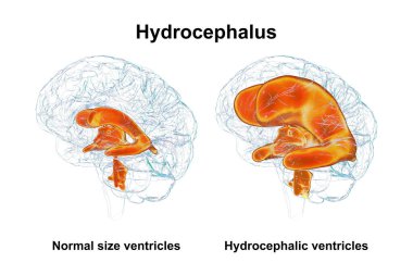 Çocuk beyninin genişlemiş ventriküllerini (hidrosefalus, sağ taraf) ve normal ventriküler sistem (sol taraf) tasvir eden üç boyutlu bilimsel bir çizim.).