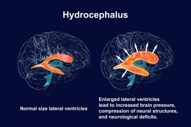 Çocuk beyninin genişlemiş yanal ventriküllerini (hidrosefalus, sağ taraf) ve normal ventriküler sistemi (sol taraf) tasvir eden üç boyutlu bilimsel bir çizim.).