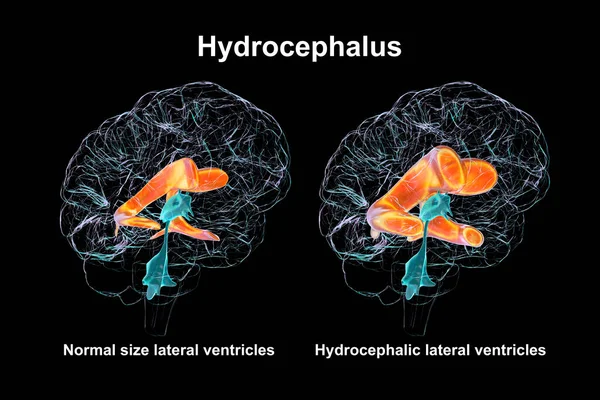 子どもの脳 ヒドロスファラス と正常な心室系 の拡大した後部心室を描いた3D科学的イラスト — ストック写真