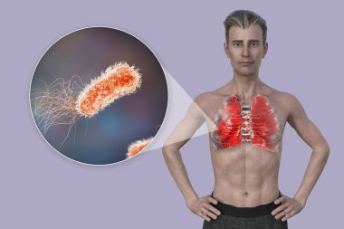 Pseudomonas aeruginosa bakterisinin yakın çekimi ve zatürreeden etkilenen akciğerleri ortaya çıkaran şeffaf derili bir adamın üst yarısını gösteren 3 boyutlu bir fotorealistik illüt..