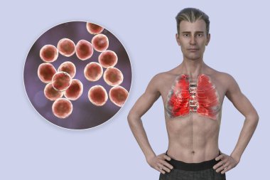 Şeffaf derisi olan bir adamın üst yarısını gösteren 3 boyutlu bir fotorealistik çizim akciğerlerin zatürreeden etkilendiğini ve Staphylococcus aureus bakterisinin yakın plan görüntüsünü ortaya çıkarıyor..