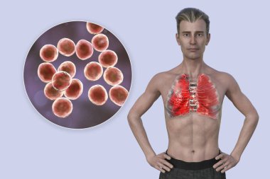 Şeffaf derisi olan bir adamın üst yarısını gösteren 3 boyutlu bir fotorealistik çizim akciğerlerin zatürreeden etkilendiğini ve Staphylococcus aureus bakterisinin yakın plan görüntüsünü ortaya çıkarıyor..