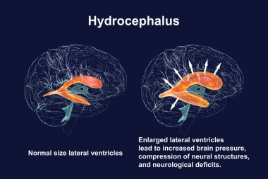 Çocuk beyninin genişlemiş yanal ventriküllerini (hidrosefalus, sağ taraf) ve normal ventriküler sistemi (sol taraf) tasvir eden üç boyutlu bilimsel bir çizim.).
