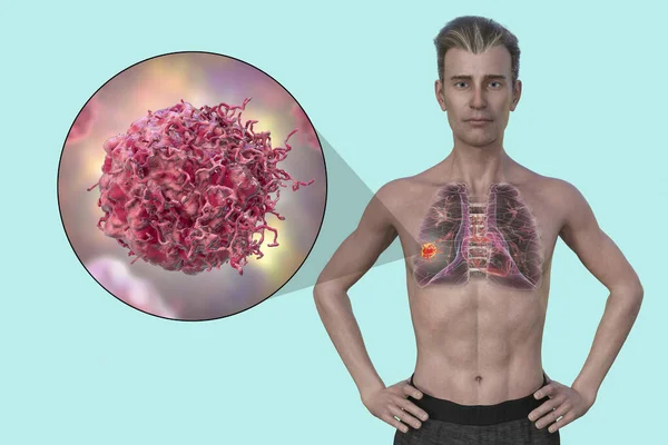 透明肌の男の上半分の3Dフォトリアリスティックなイラスト 肺癌の存在を明らかにし 癌細胞のクローズアップビュー — ストック写真