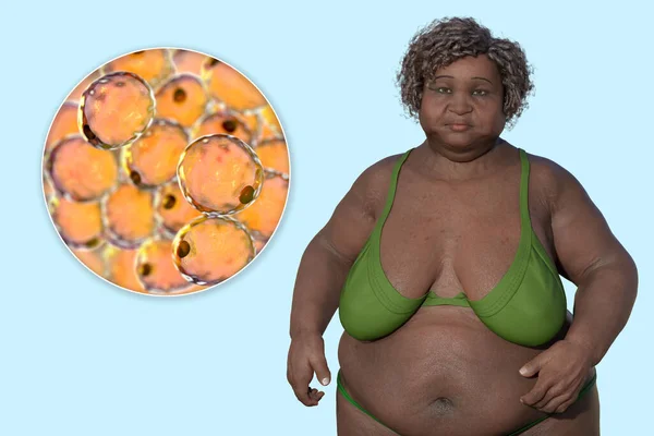 脂肪細胞のクローズアップビューを持つ太りすぎの女性を描いた3D医療イラストは 肥満におけるこれらの脂肪細胞の役割を強調しています — ストック写真
