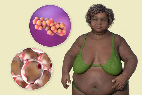脂肪細胞とコレステロール分子のクローズアップビューを持つ太りすぎの女性を特徴とする3D医療イラストは 肥満とコレステロール代謝の関係を強調しています — ストック写真