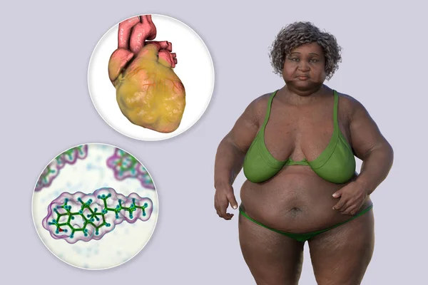 Молекула Холестерина Ожирения Сердца Женщины Избыточным Весом Иллюстрация Концепция Ожирения — стоковое фото