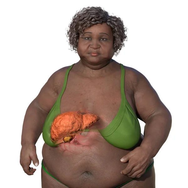 透明な肌を持つ太りすぎの女性をフィーチャーした3D医療イラストで 肝臓を紹介し 肝臓ステアトシスの存在を強調します — ストック写真