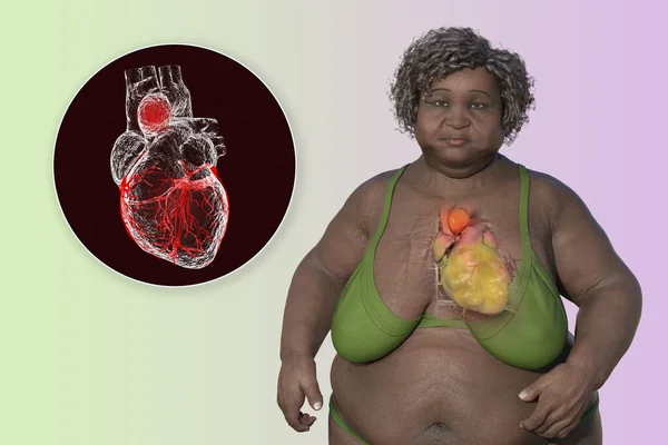 Scientific Illustration Depicting Obese Woman Transparent Skin Revealing Ascending Aortic — Stock Photo, Image