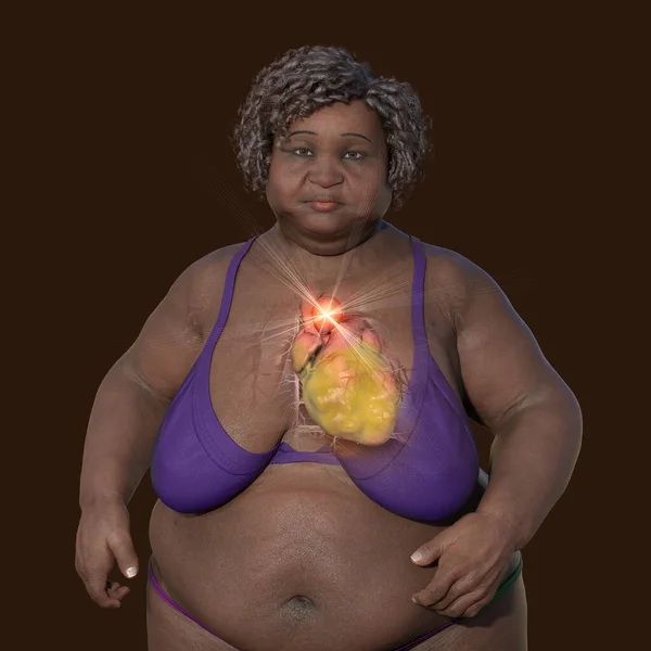 透明な肌を持つ肥満の女性を描いた3D科学的イラスト 上昇する動脈瘤を明らかにする 肥満の動脈上昇の関連性を強調する概念 — ストック写真