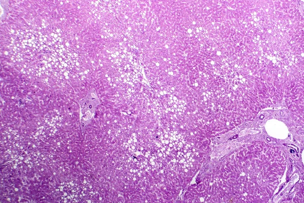 Photomicrograph of hepatic steatosis, revealing fat accumulation in liver cells, known as fatty liver disease.