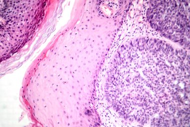 Bazal hücre kanserinin fotomikrografı, en yaygın cilt kanserinin tipik kötü huylu bazal hücrelerini gösteriyor..