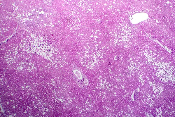 肝脏脂肪沉着症的显微照片 显示肝细胞中的脂肪堆积 称为脂肪性肝病 — 图库照片