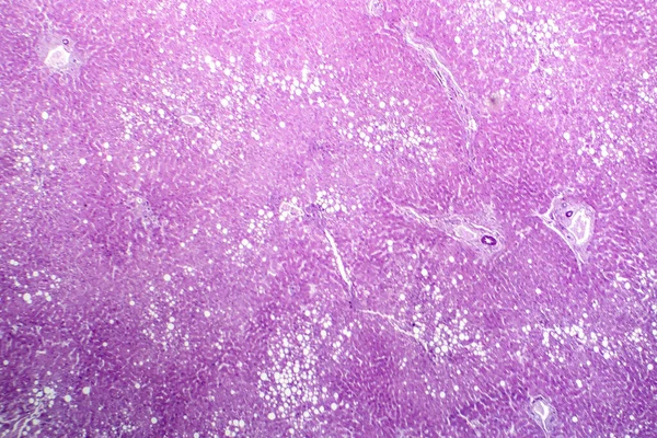 Májsteatosis Fotomikrográfja Kimutatja Zsírfelhalmozódást Májsejtekben Amit Zsírmájbetegségnek Neveznek — Stock Fotó