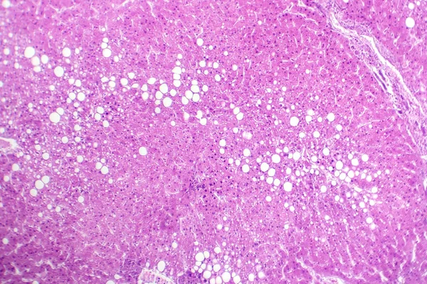 Фотомікрограф Печінкового Стеатозу Виявляє Накопичення Жиру Клітинах Печінки Відомий Жирові — стокове фото