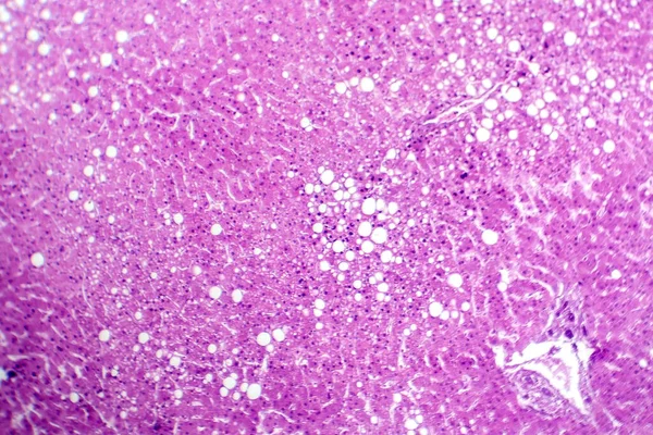 Fotomicrografía Esteatosis Hepática Revelando Acumulación Grasa Las Células Hepáticas Conocida — Foto de Stock