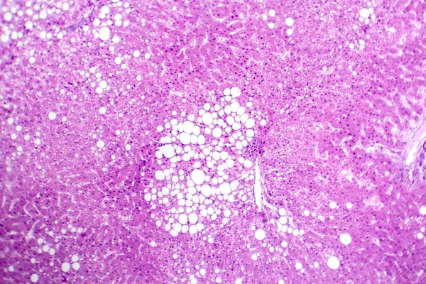 Photomicrograph Hepatic Steatosis Revealing Fat Accumulation Liver Cells Known Fatty — Stok Foto