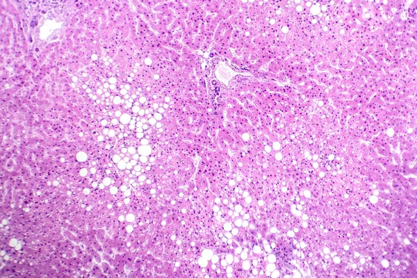 스테아티스의 포토그래프 지방간 질환으로 알려진 간세포의 축적을 밝히는 — 스톡 사진